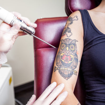 Factors To Consider Before Visit A Tattoo Removal Service